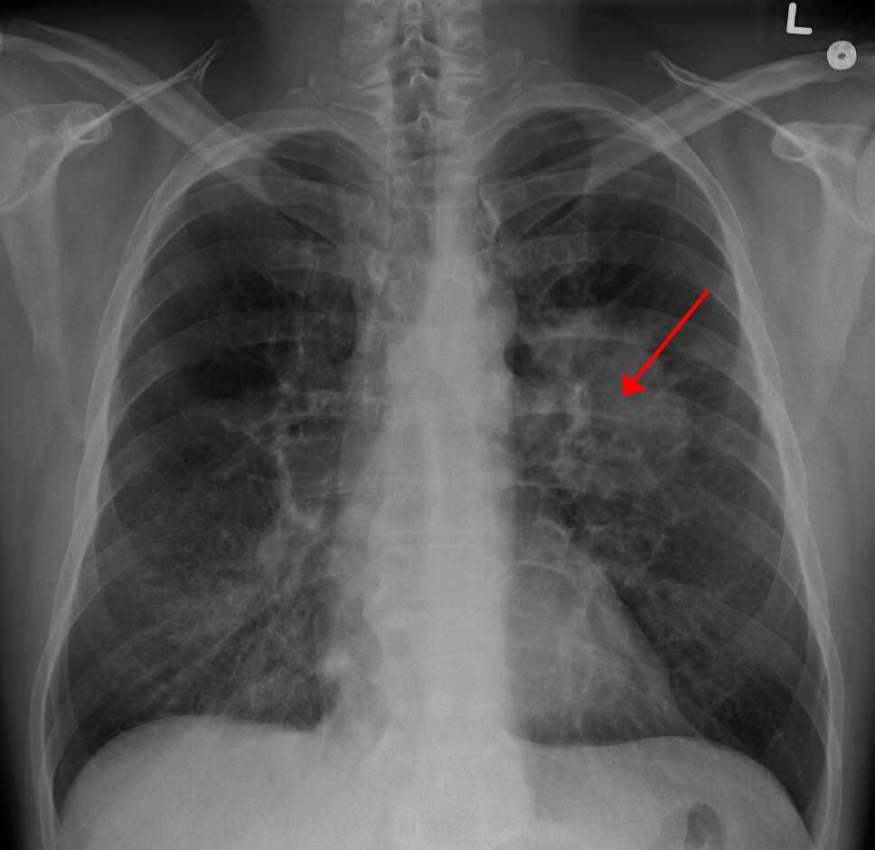 Penyakit yang Bisa Dideteksi PET Scan